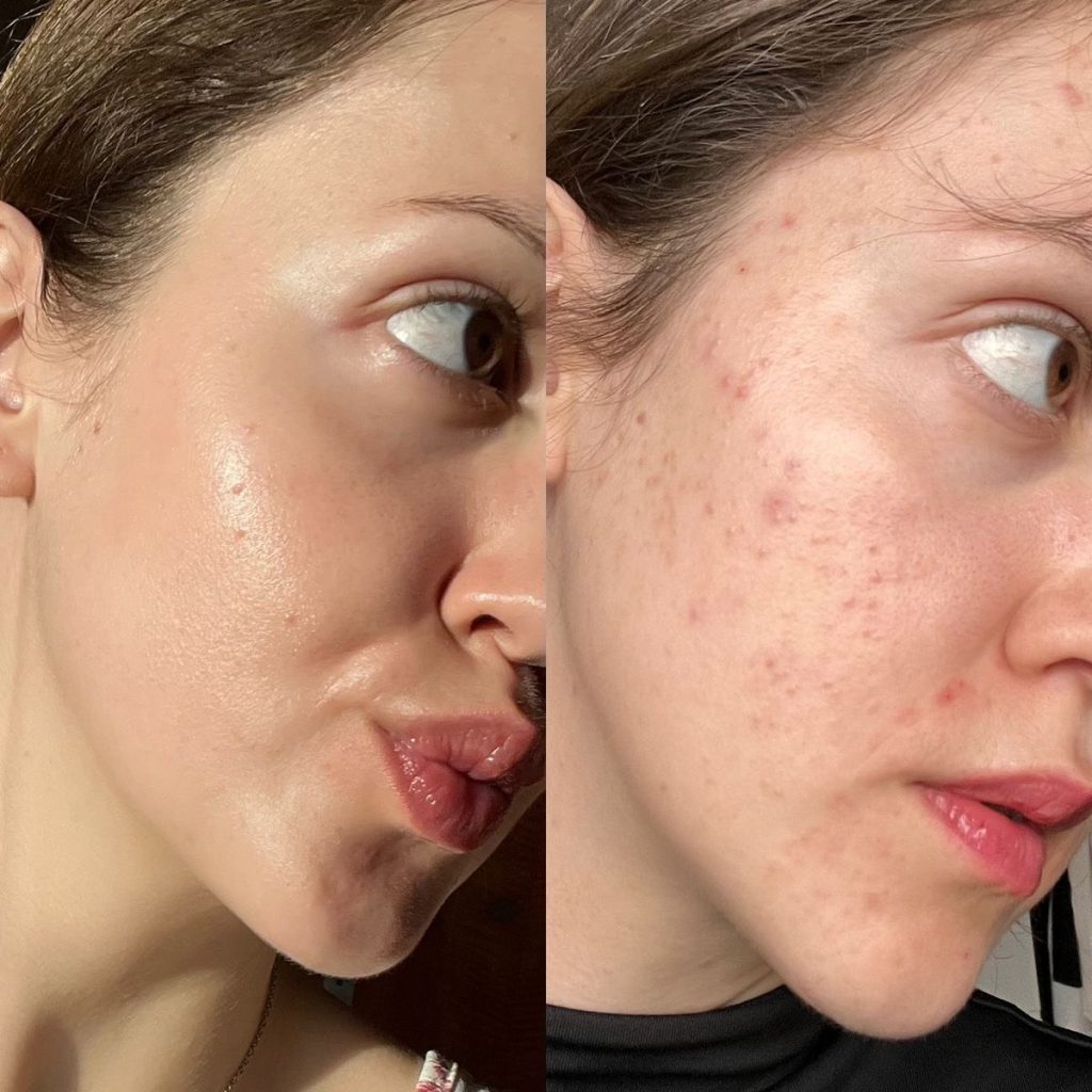 `روتین ضد جوش کامل؛راهنمای علمی برای داشتن پوستی صاف وشفاف - آریحل|نمایندگی محصولات تراست`